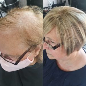 hair replacement worcester