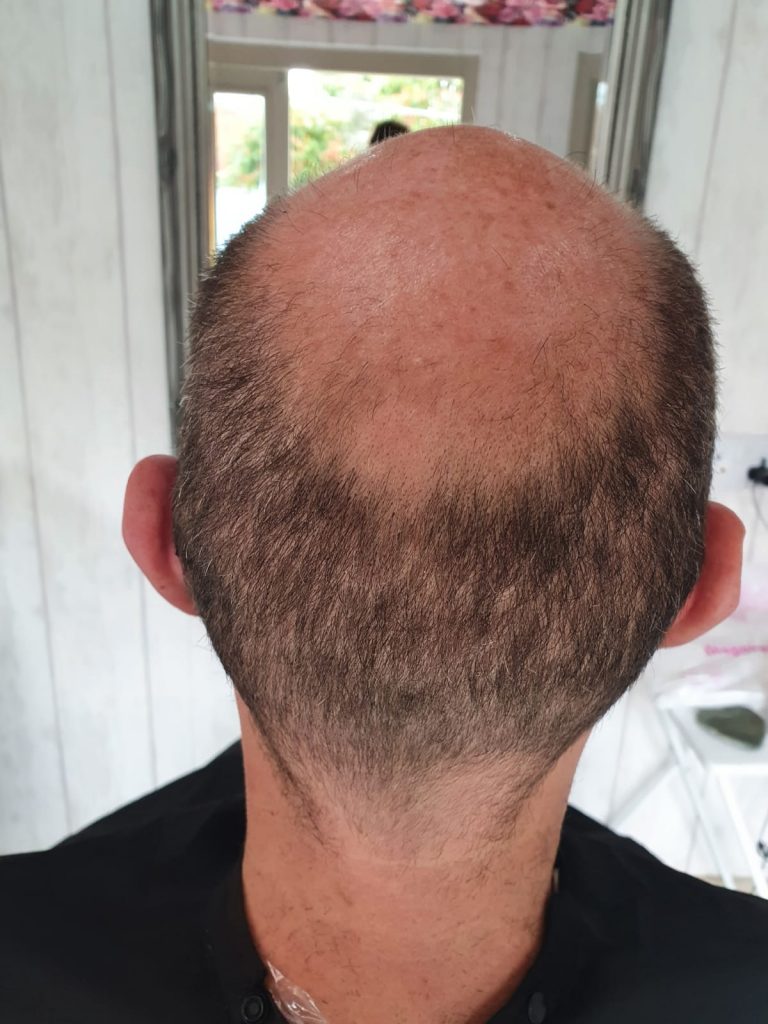 mens-hair-loss-treatment-worcester