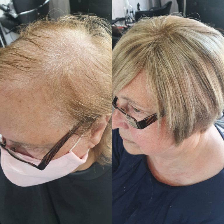 hair-replacement-worcester